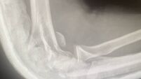 Teen suffers broken arm in filmed beating Teen suffers broken arm in filmed beating