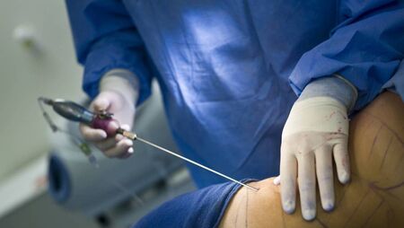 Judge revokes Laois woman’s free legal aid after learning she had paid for “liposuction, tummy tuck and a butt lift.” Judge revokes Laois woman’s free legal aid after learning she had paid for “liposuction, tummy tuck and a butt lift.”